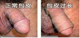 包皮过长